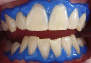 Teeth Whitening Adelaide