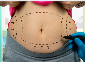 Central-Day-Surgery tummy tuck Adelaide