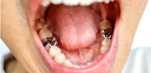 Dental fillings Adelaide: Dental Fillings 