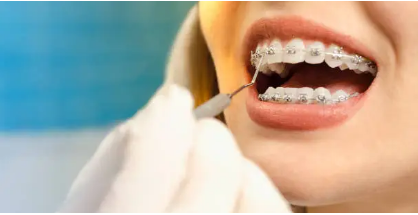 dental braces Adelaide